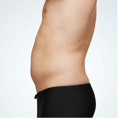 aureal-coolsculpting-addome-prima